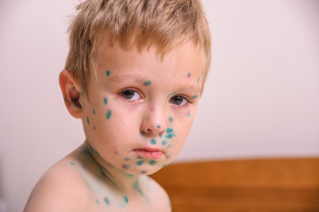 Jonge peuter, jongen met waterpokken. Ziek kind met waterpokken. Varicella-virus of waterpokken bubbeluitslag op het lichaam en gezicht van het kind.