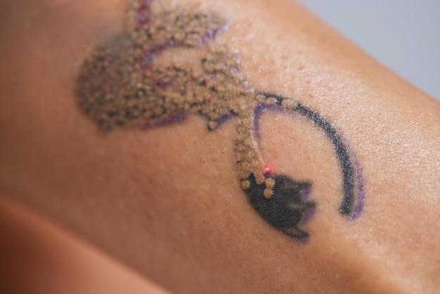 Foto jonge vrouw die een laser-tatoeageverwijderingsprocedure ondergaat in de salonclose-up