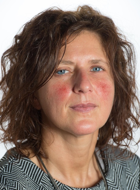 Jonge vrouw met rode wangen door acneïforme rosacea