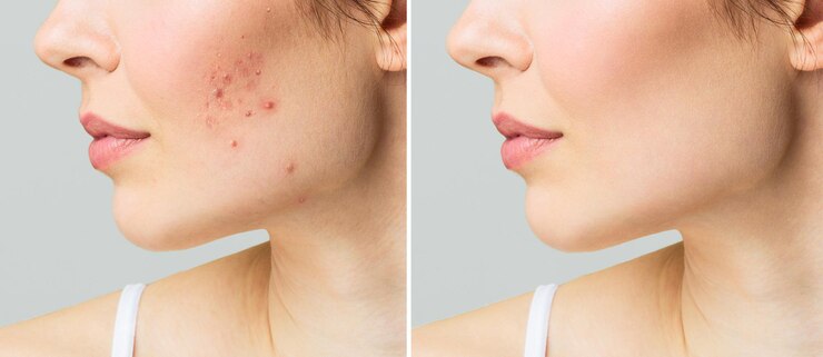 Jonge vrouw voor en na acne behandeling huidverzorging concept