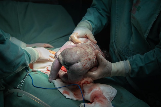 Foto keizersnede bevallingsprocedure in het ziekenhuis