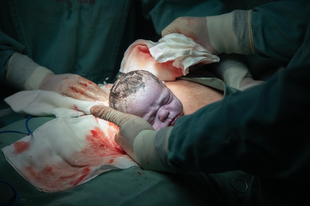 Keizersnede bevallingsprocedure in het ziekenhuis