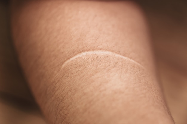 写真 ケロイド。ナイフカット傷からい女性の腕の皮膚の傷