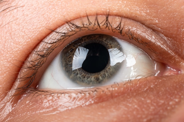 Keratoconus eye closeup , thinning of the cornea.