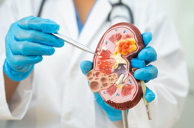 kidney disease chronic kidney disease ckd doctor hold human model to treat and study in hospital