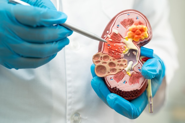 Kidney disease Chronic kidney disease ckd Doctor hold model to study and treat in hospital