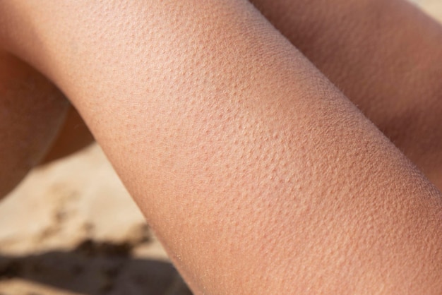 Foto kippenvel op de benen van een jonge vrouw zittend op het strand contrasterende lucht en zonnebaden