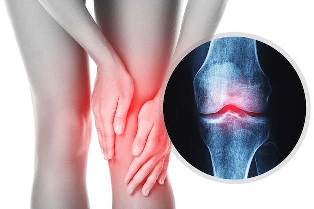 Фото Эффект колена и рентгена при травмированном суставе