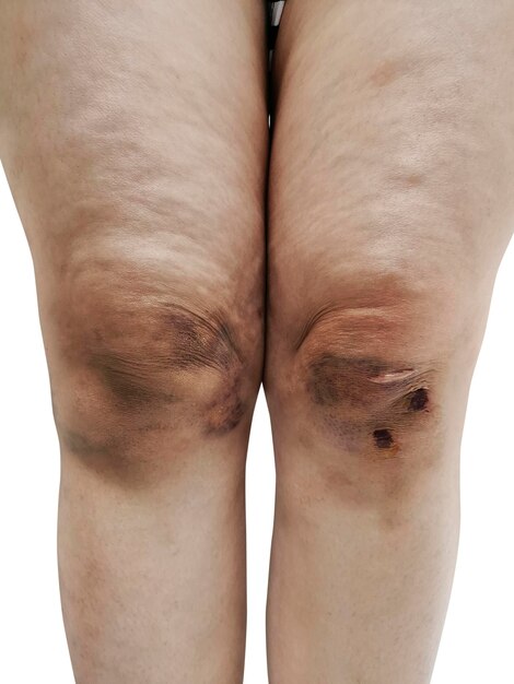knee bruise due to slipping accident transparent background