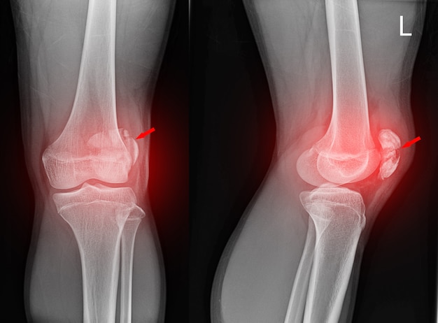 Knee joint x-ray