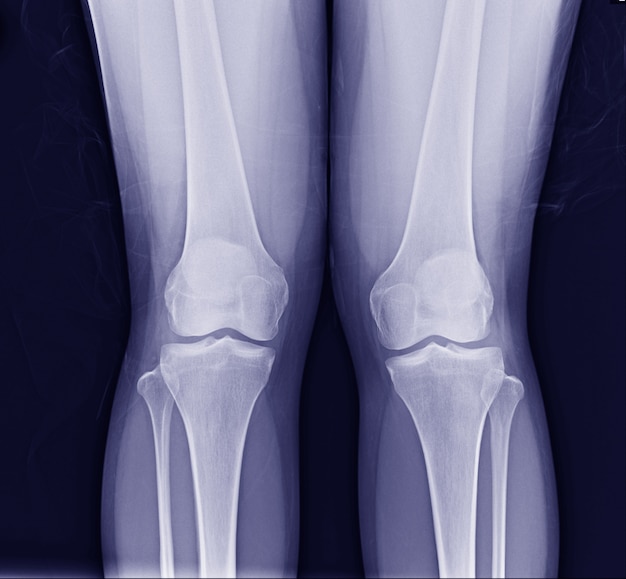 рентгенография коленного сустава