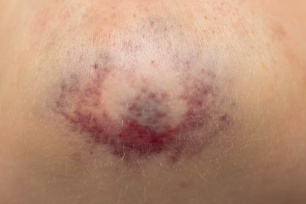 Knie met blauwe huidirritatie van dichtbij