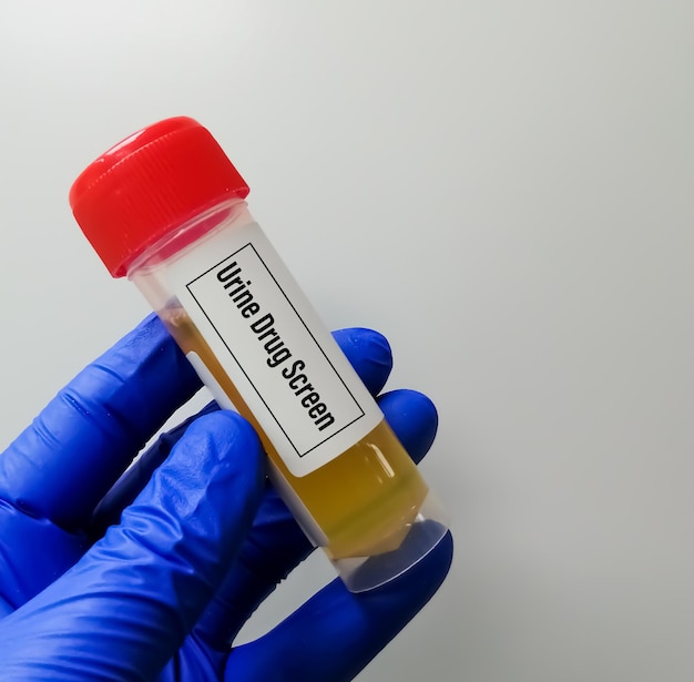 Lab technician holds Urine sample for drug screen test, illegal drugs testing