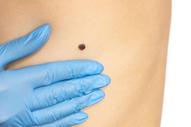 A large mole on the back of a young woman A doctor examines a dark brown spot