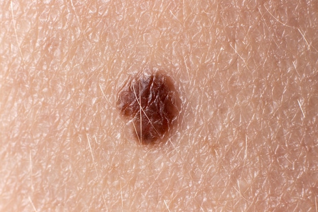 A large mole on human skin with space for text.