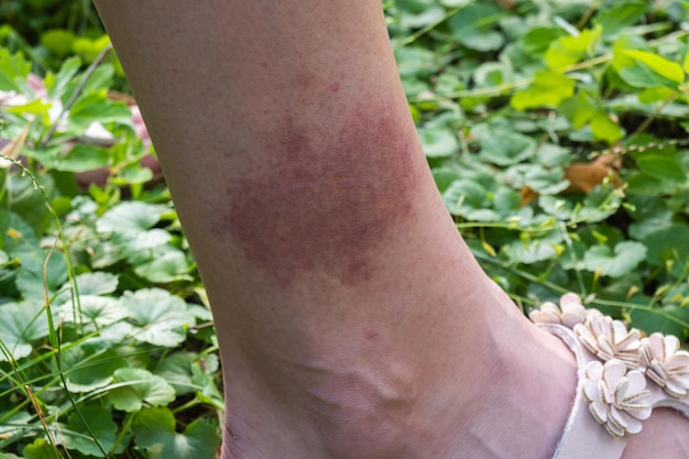 Photo large red spot on the leg after a tick bite closeup lyme disease