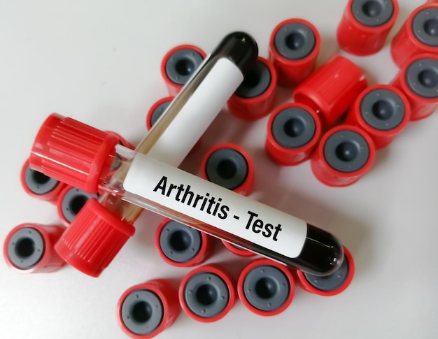 A large red and white test tube with the word " arthritis test " on it.