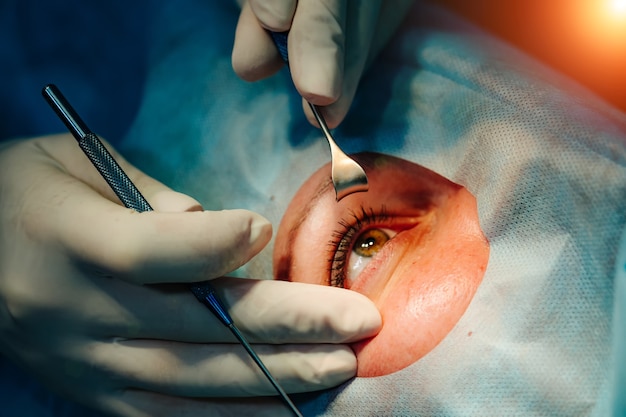 Laser correction for vision. Ophthalmology surgery for eyes. Vision correction.