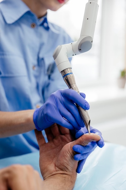 Laser removal of warts on a man's hand in a cosmetology clinic