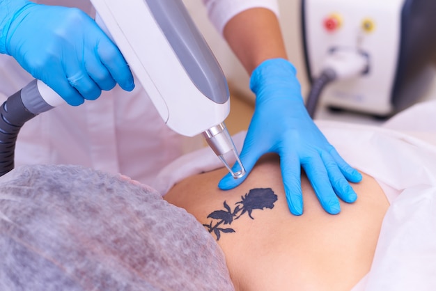 Photo laser tattoo removal in a cosmetology clinic.