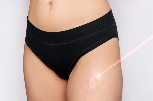 Laserlittekenverwijdering Bijgesneden opname van jonge vrouw met een brandwondlitteken op haar dij met een rode laserstraal