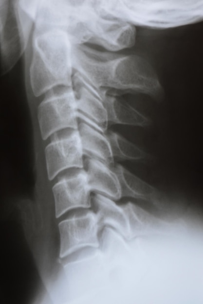 Radiografia laterale del collo e del rachide cervicale di una persona