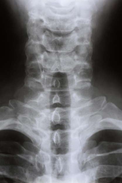 사진 사람의 목과 경추의 측면 xray