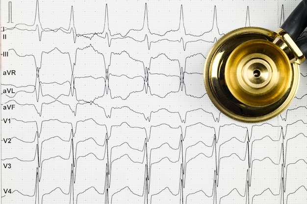 Layout on the table an ECG with rhythm disturbance a stethophonendoscope