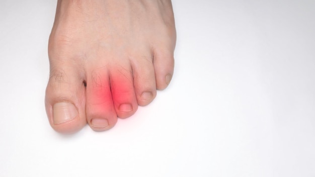 Left foot toes of a person with a red mark representing pain