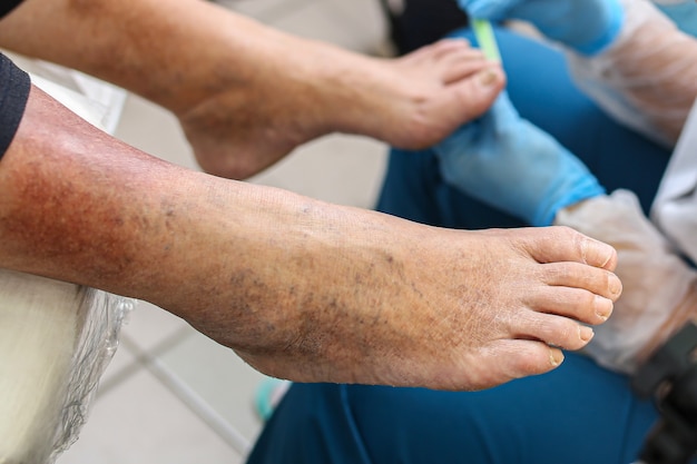 Leg vein disease, dark spots on the skin of the legs, treatment, examination of toenails, fungus.