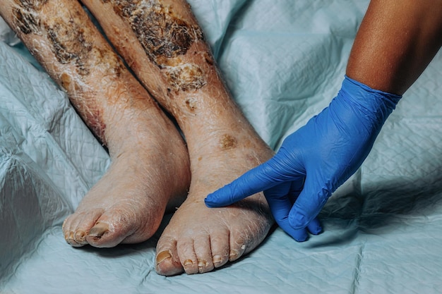 Photo on the legs of an elderly woman the skin peels off due to eczema swelling of the legs yellowing of the nail plate swelling of the legs consequences of diabetes in the elderly elderly care