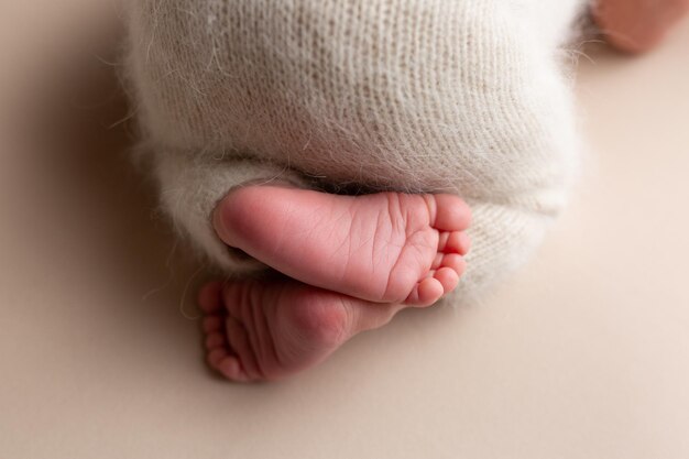 legs of a newborn with crusts on the skin. acne newborn