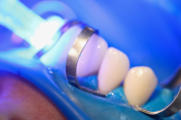歯科医院のクローズ アップでベニアのインストール中に歯に当たる光