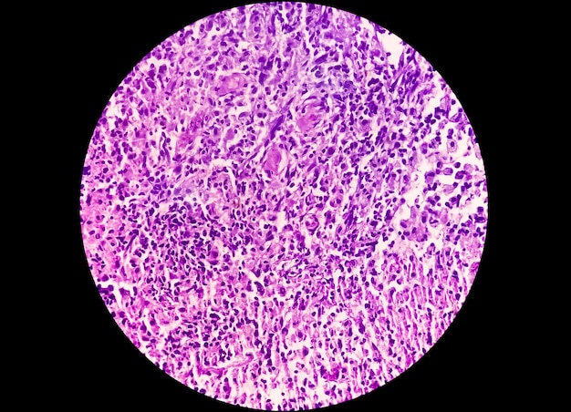 Photo light photomicrograph of stained slide of histology showing carcinoma