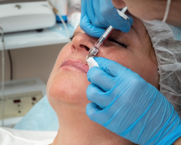 Lip augmentation lip correction hyaluronic acid preparation age caucasian woman