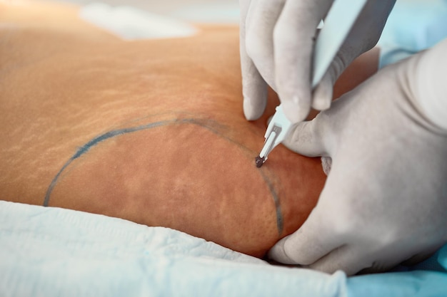 Liposuction corrective plastic surgery for liposuction of fat deposits in the abdomen beauty and