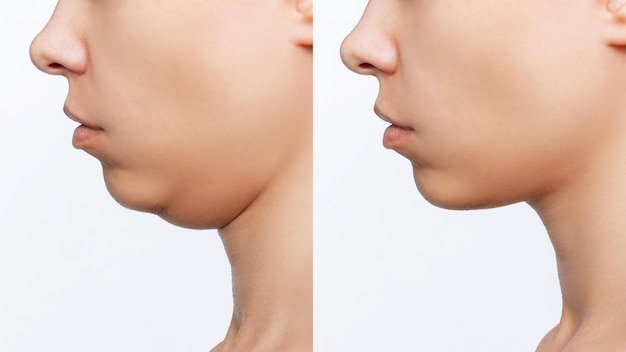 Photo liposuction of double chin cropped shot of woman's face with chin before and after plastic surgery