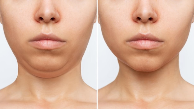 写真 二重あごの脂肪吸引。美容整形手術前後のあごを持つ女性の顔