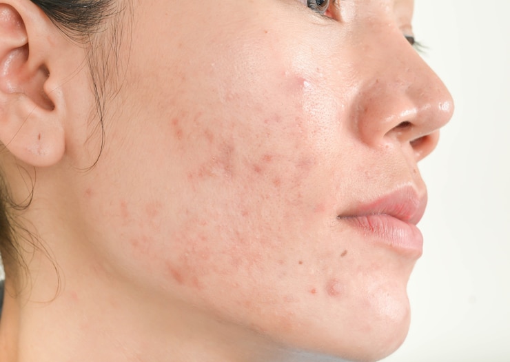 Foto litteken van acne op gezicht