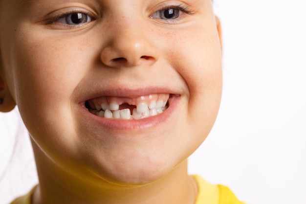 Little girl face smiling showing missing front baby tooth looking away on white background First teeth changing going to dentist to do tooth treatment