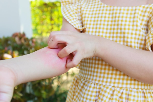 사진 어린 소녀는 피부 발진 알레르기가 있고 팔이 가렵다