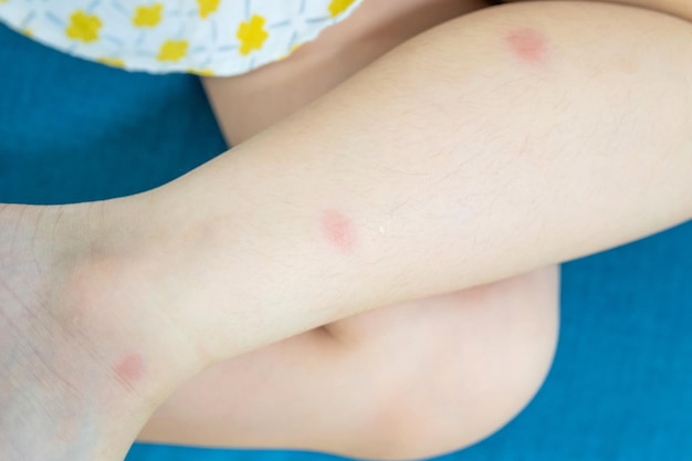 Little girl has skin rash allergy itching on her leg