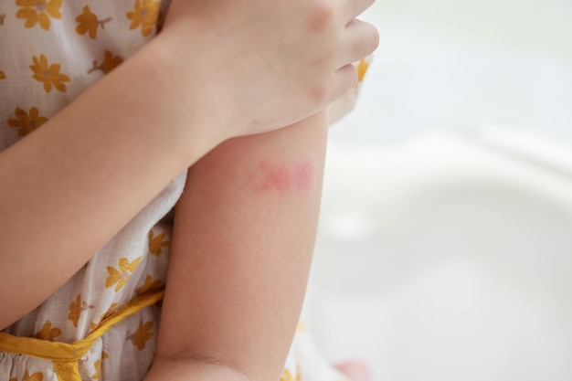小さな女の子は皮膚発疹アレルギーで 腕にかき傷をつけています
