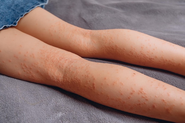 Little girl's legs covered with pigmented spots of red color lying on a gray soft blanket Human body parts