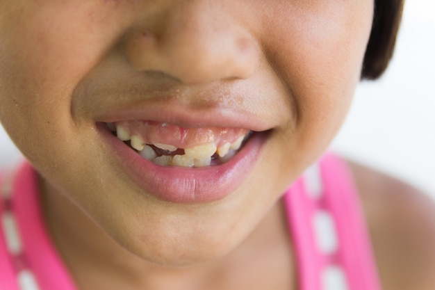 Photo little girl with a teeth broken and rotten