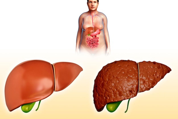 Photo liver cirrhosis illustration