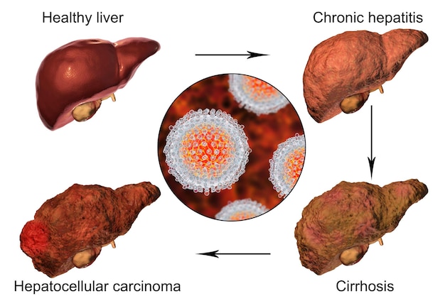 Liver disease progression in Hepatitis C virus infection 3D illustration