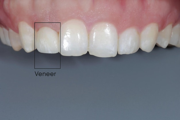 照片陶瓷薄单板上的位置排牙齿真实人类下巴医学概念