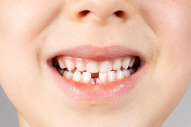 Premium Photo | Loss of milk teeth in children a sixyearold child shows