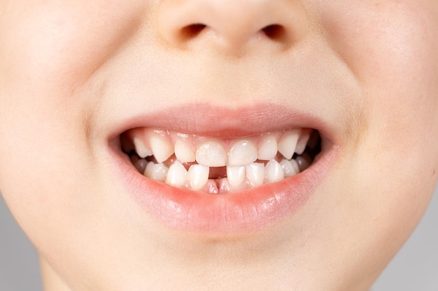 Loss of milk teeth in children A sixyearold child shows the first baby tooth that has fallen out